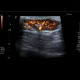 Lymph node, inflammatory, groin: US - Ultrasound